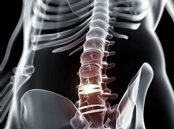 Epidural Steroid Injections Miramar Fl Spine Specialists